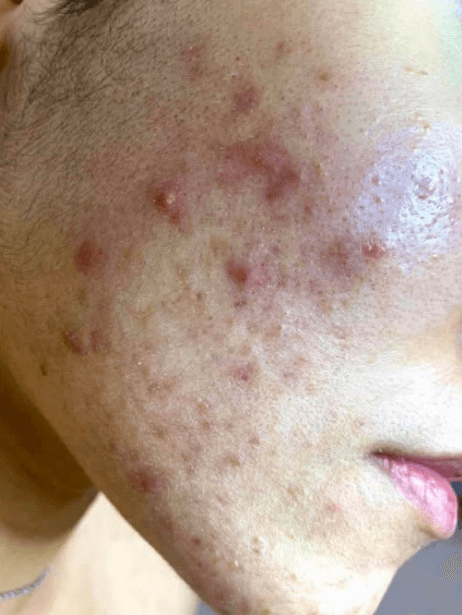 Face before treatment